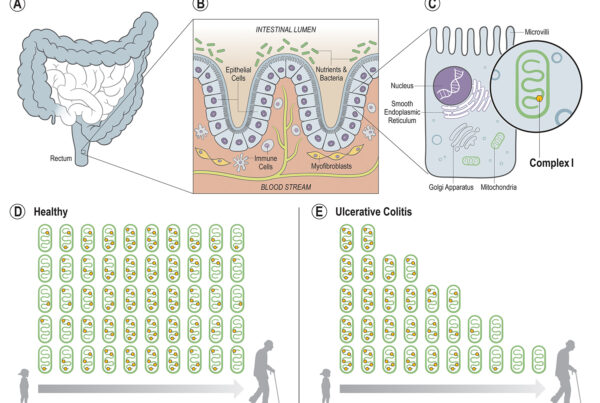 Graphical Abstract Ulcerative Colitis