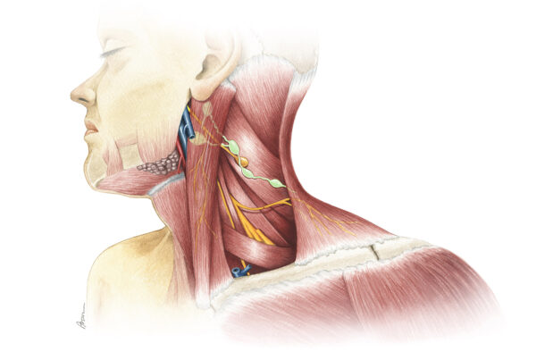 Nerve Transfer to Damaged Accessory Nerve