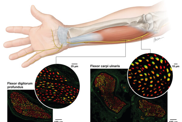 Axons of FCU and FDP Nerves